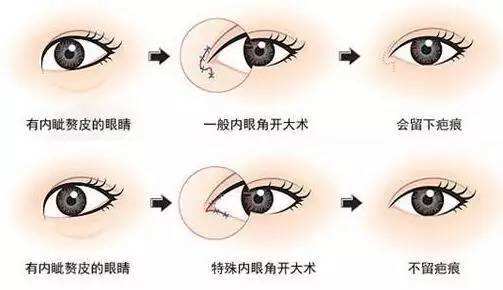 杭州雙眼皮修復(fù)知名專家排行榜  杭州最好的雙眼皮修復(fù)專家排名 杭州最好的雙眼皮修復(fù)專家有哪些？