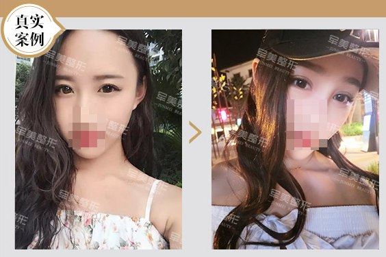 雙眼皮案例