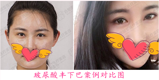 豐下巴案例