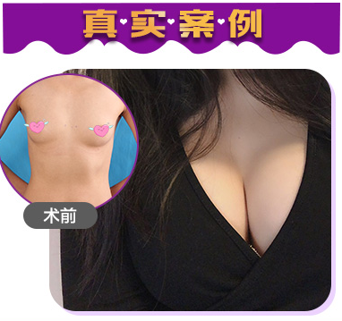 董巖巖豐胸案例