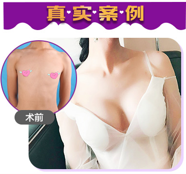董巖巖豐胸案例