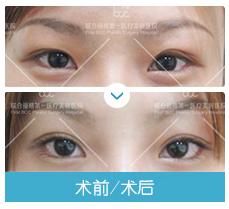 眼修復