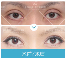 眼修復