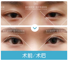 眼修復