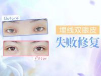 北京雙眼皮修復(fù)整形專家王世勇和王振軍哪個更好？