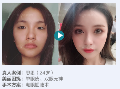 雙眼皮案例