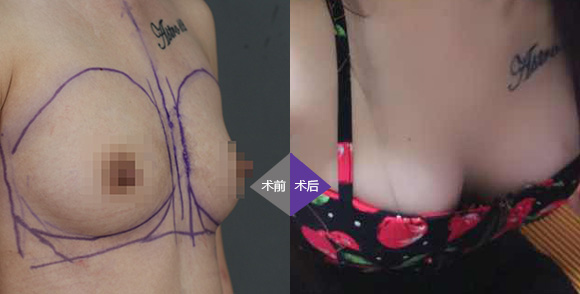 豐胸案例