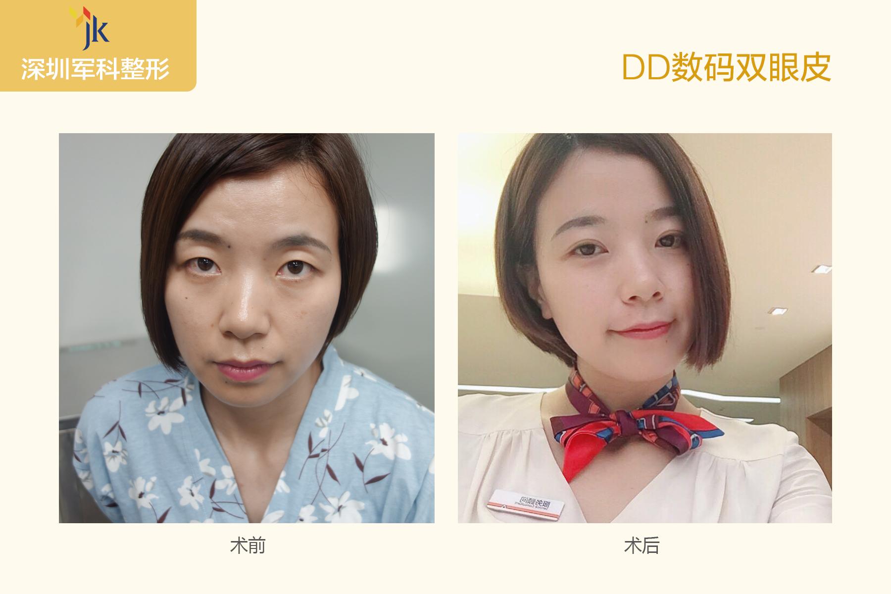 劉月更雙眼皮案例