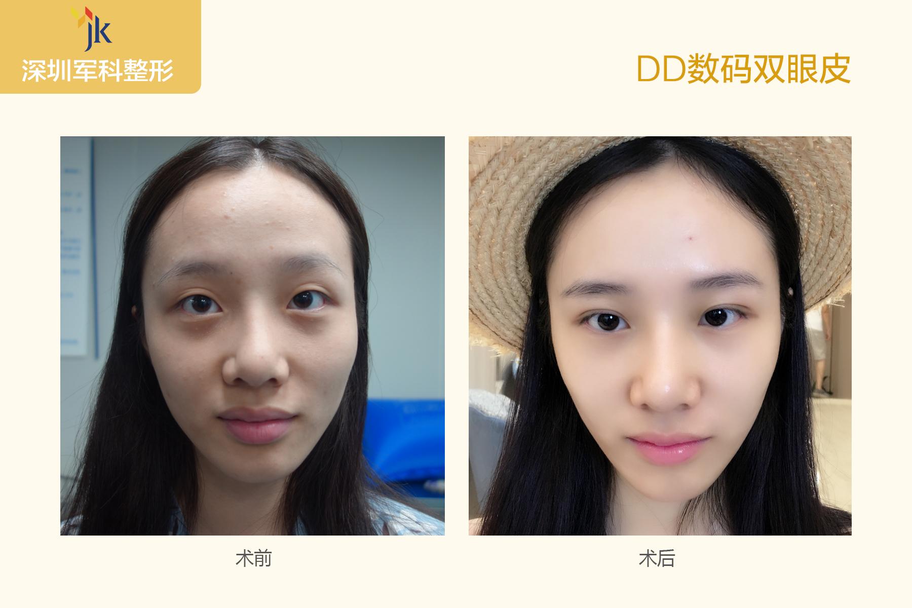 劉月更雙眼皮案例