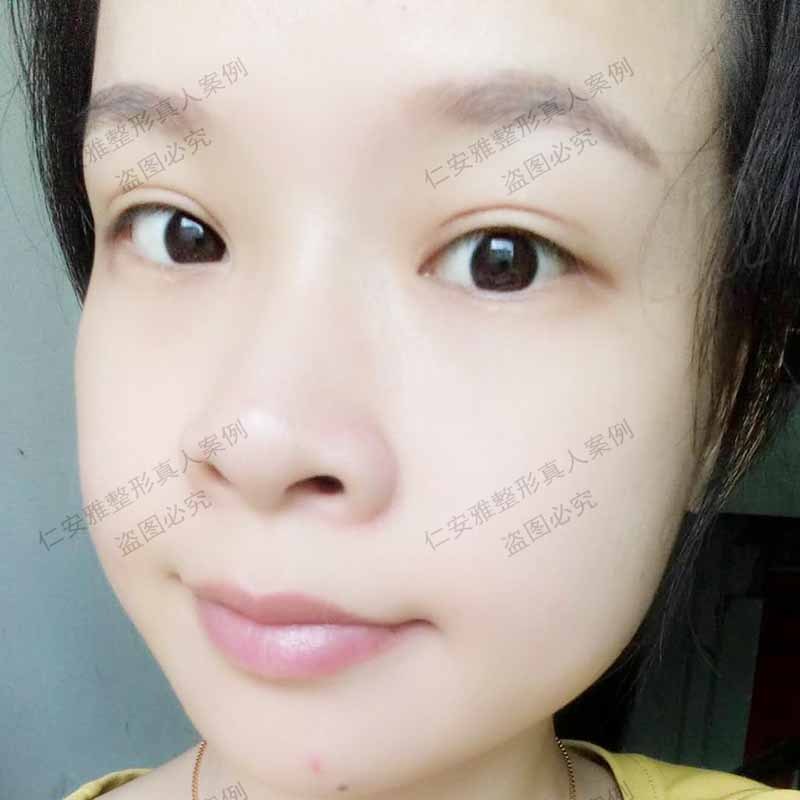苗春來雙眼皮案例