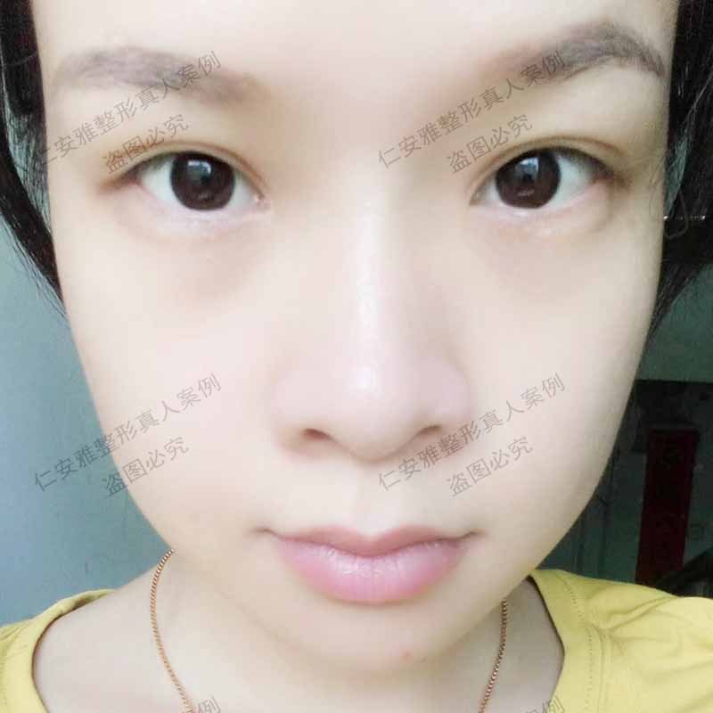 苗春來雙眼皮案例