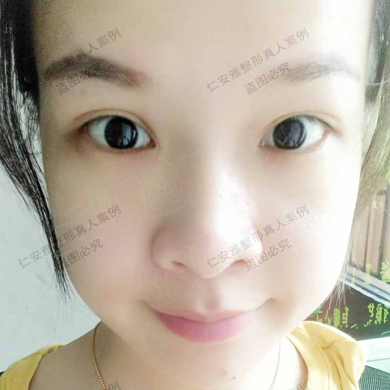苗春來雙眼皮案例