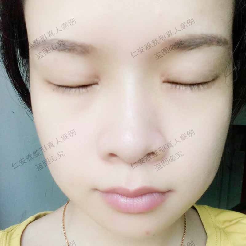 苗春來雙眼皮案例