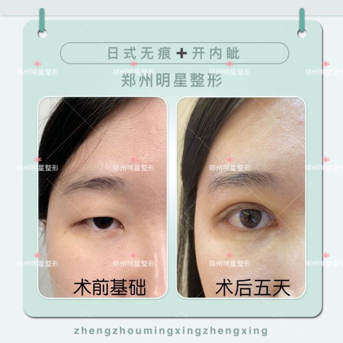 日式無(wú)痕雙眼皮案例