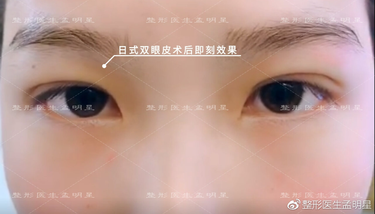 日式無(wú)痕雙眼皮案例