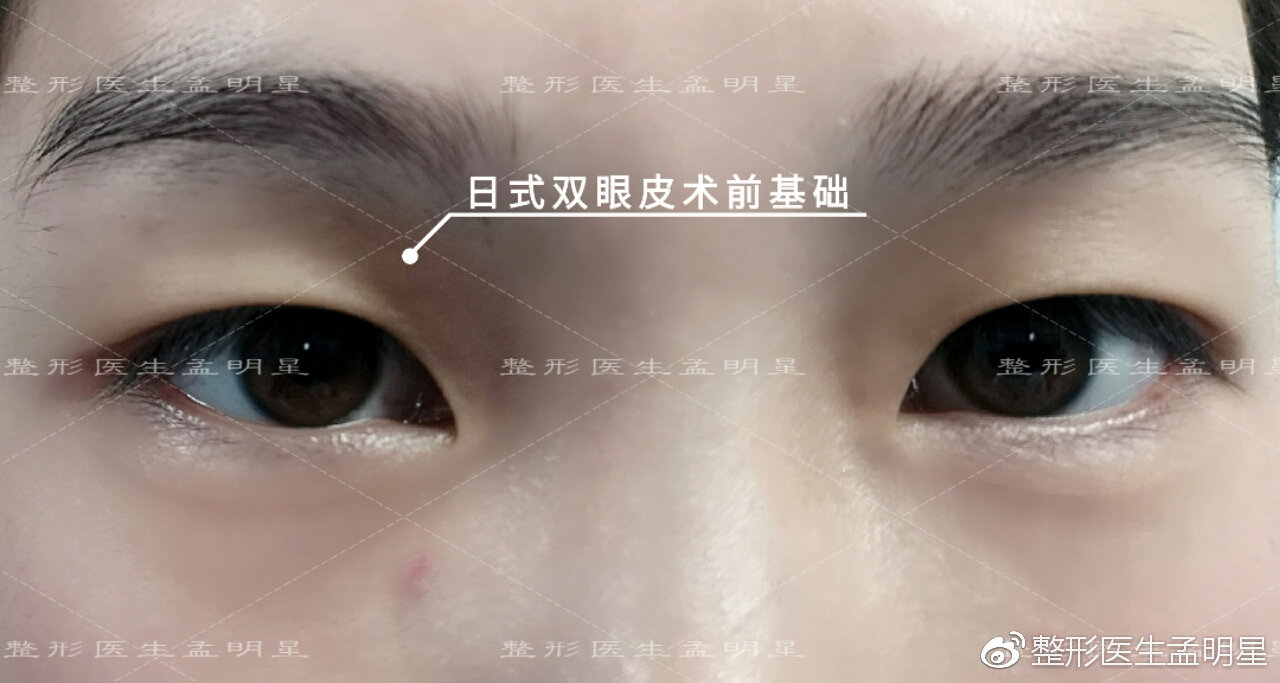 日式無(wú)痕雙眼皮案例