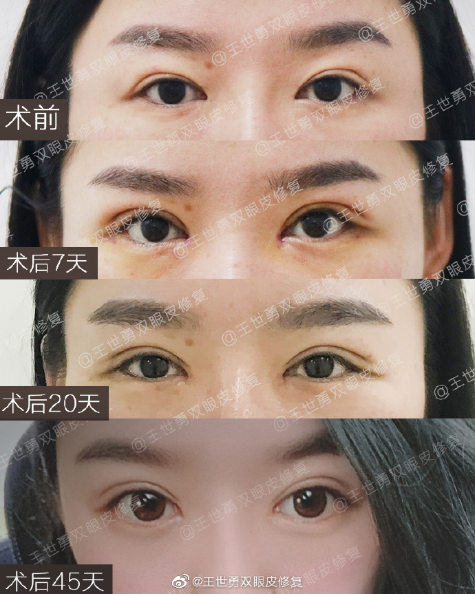 王世勇雙眼皮修復案例