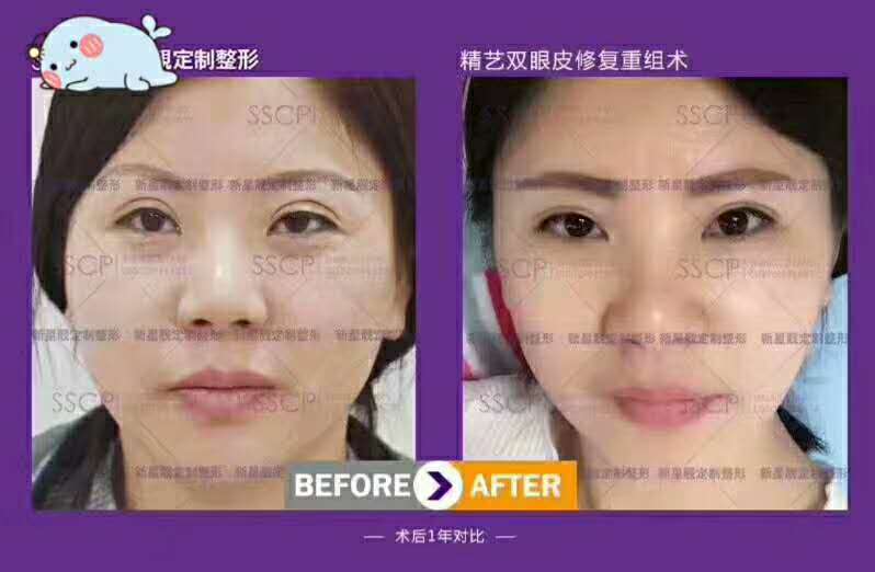 劉風卓雙眼皮修復
