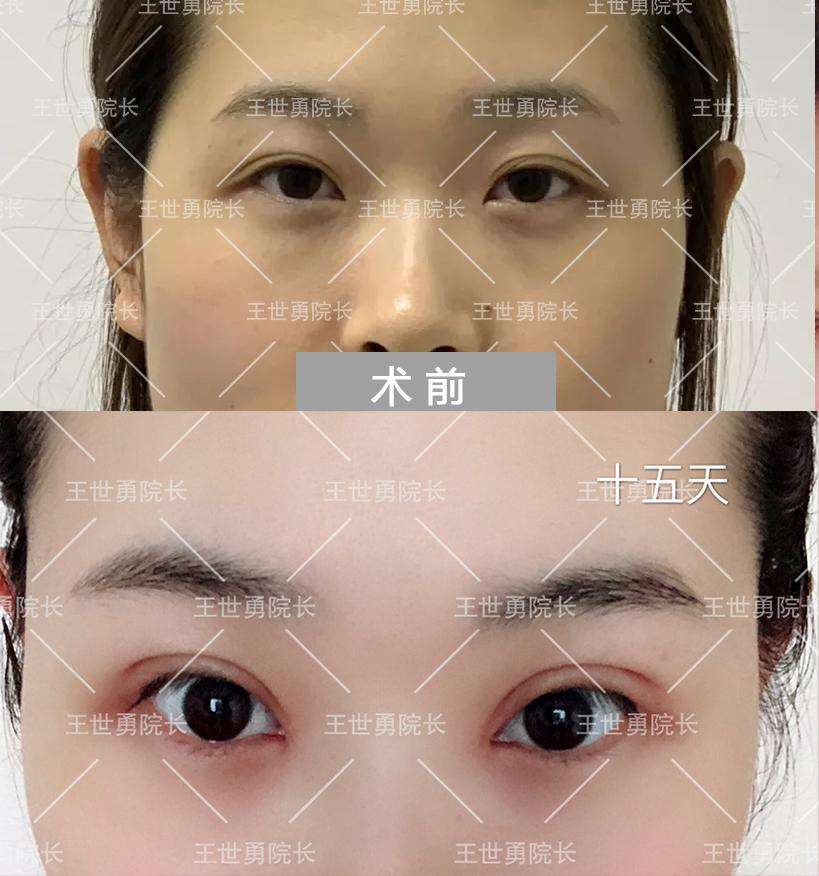 中國哪一位醫生修復雙眼皮最好？