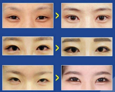 雙眼皮案例