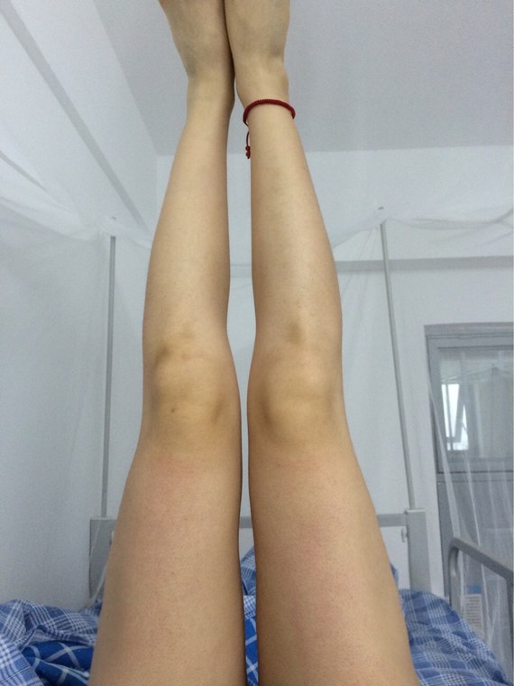 大腿抽脂凹凸不平哪位專家修復(fù)好?怎么修復(fù)的?