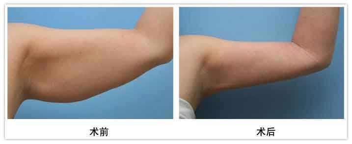 全國吸脂塑形權威專家排行榜各個地區都有哦