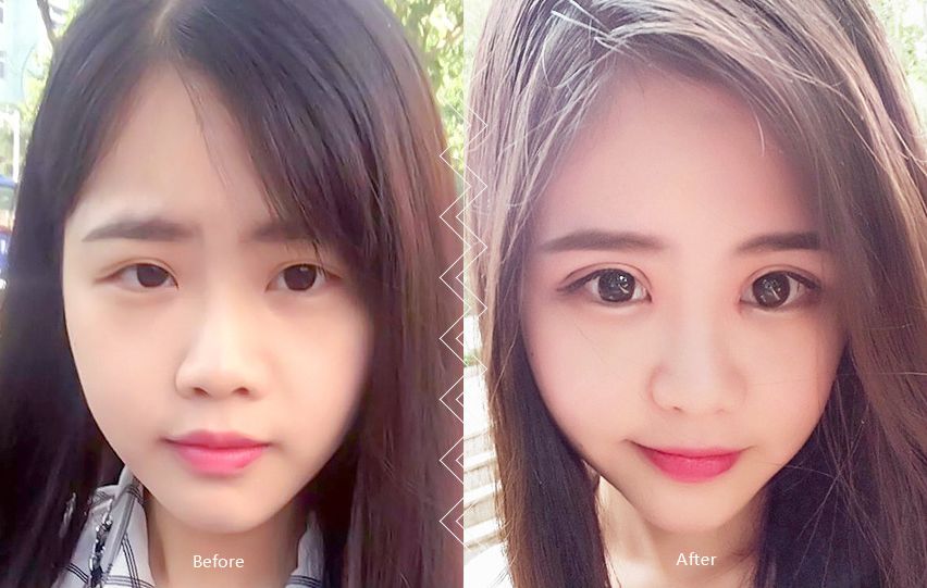 雙眼皮案例