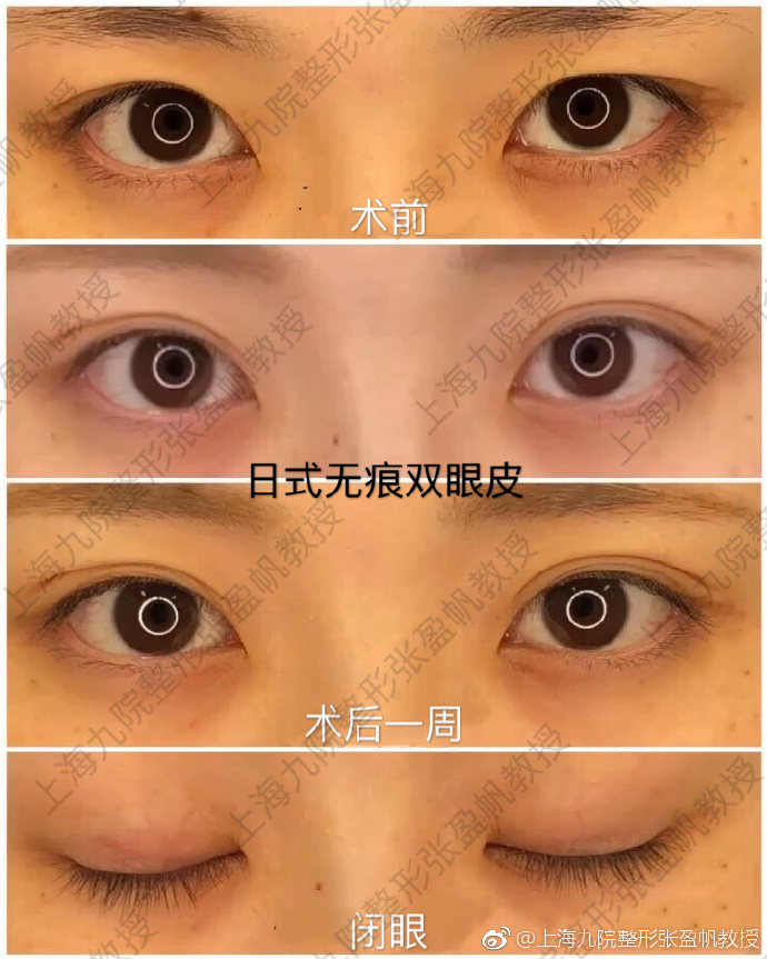孫盈帆日式無痕雙眼皮案例