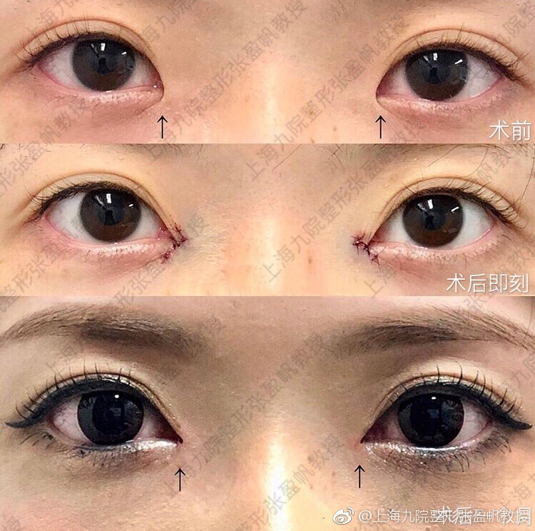 內眼角修復案例