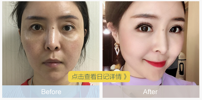 徐曉雯雙眼皮修復案例