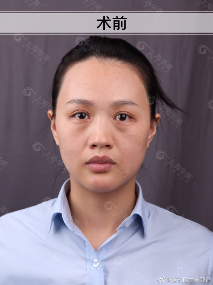 楊亞益雙眼皮修復案例
