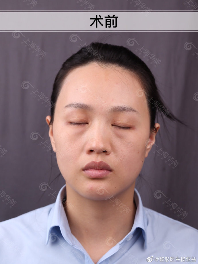 楊亞益雙眼皮修復案例