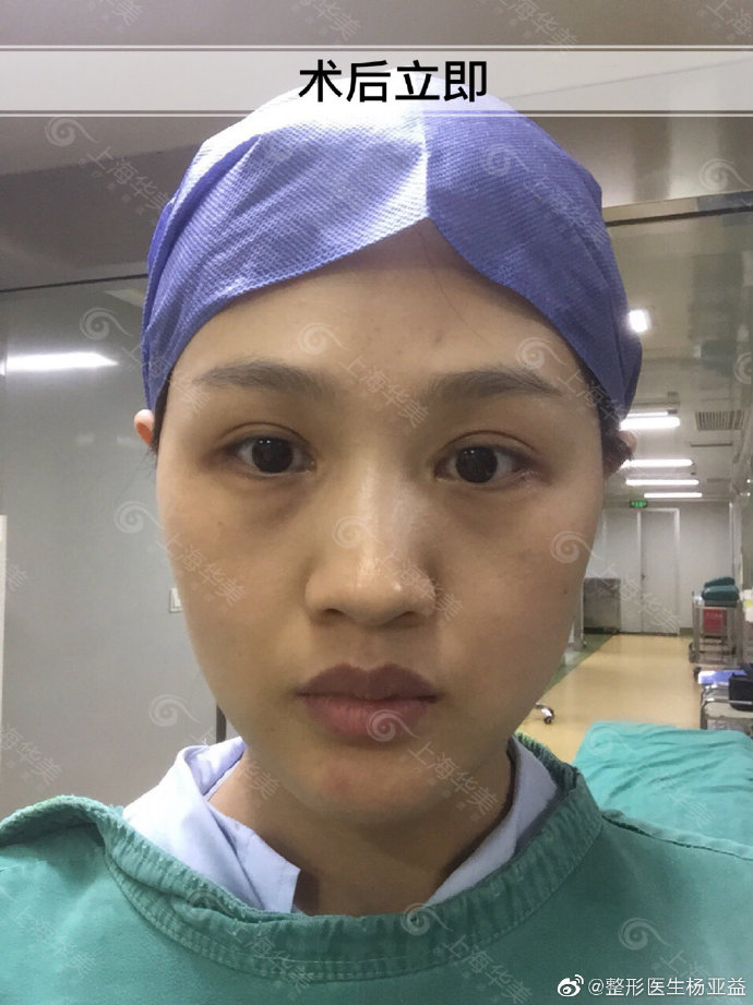 楊亞益雙眼皮修復案例