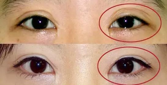 上海最好的修復(fù)雙眼皮專家排行榜