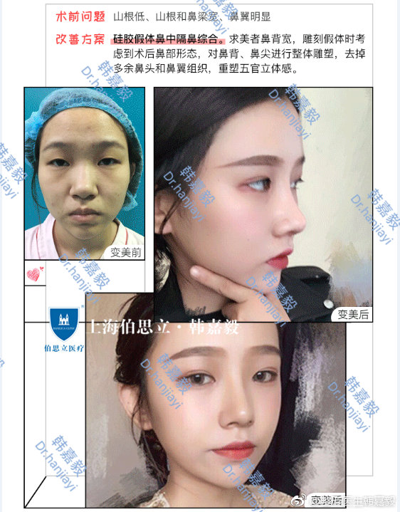 韓嘉毅隆鼻案例
