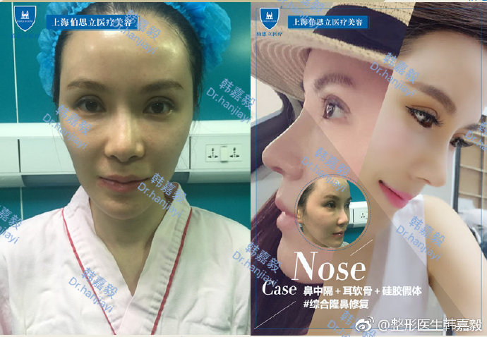 韓嘉毅鼻綜合
