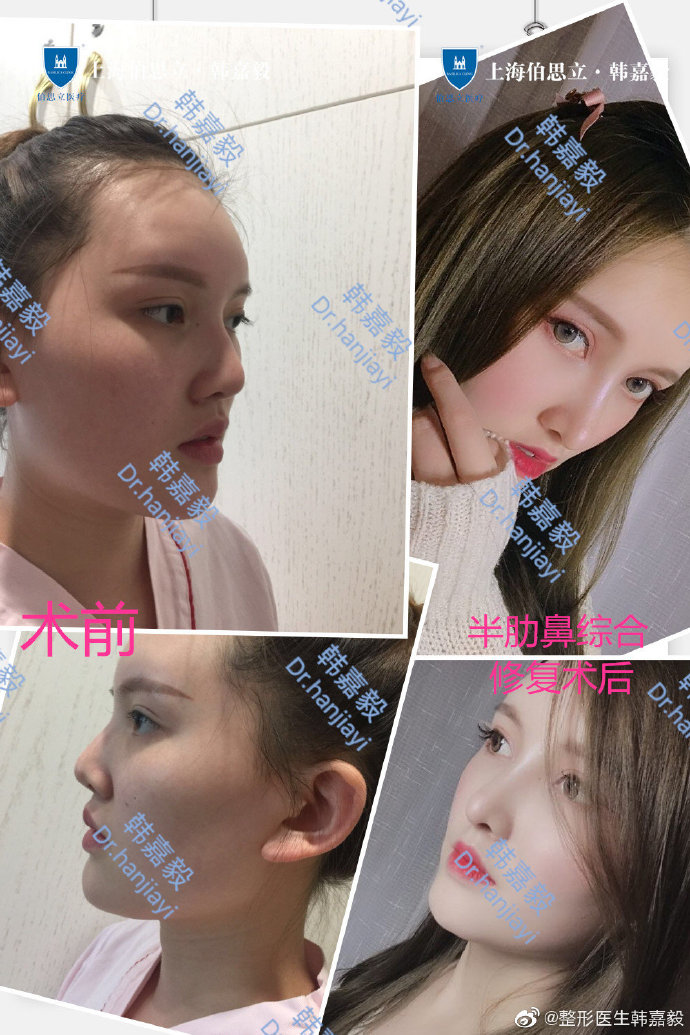 韓嘉毅鼻修復案例