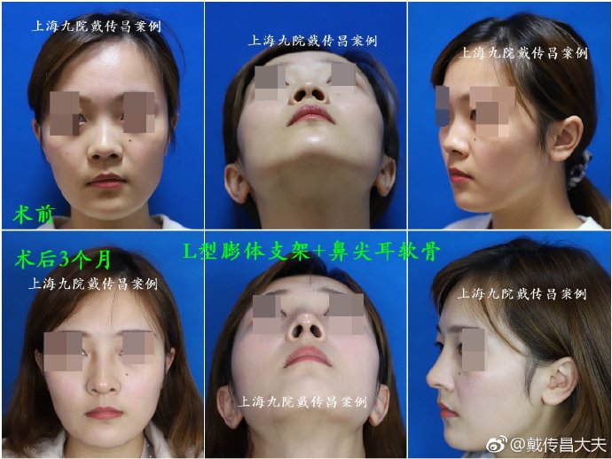 戴傳昌隆鼻案例