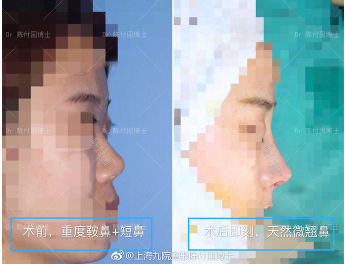 陳付國隆鼻案例