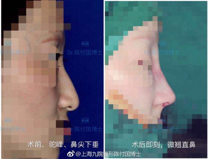 陳付國隆鼻案例