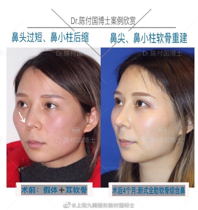 陳付國隆鼻案例