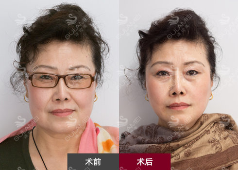 孫瑋駿面部提升案例