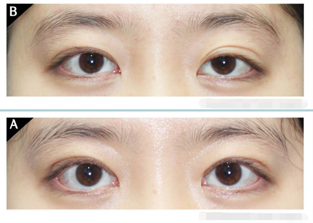 山西太原雙眼皮醫生技術好的都有哪些？求推薦！