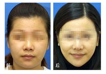 重慶下頜角削骨、顴骨內推哪個醫生做的好?