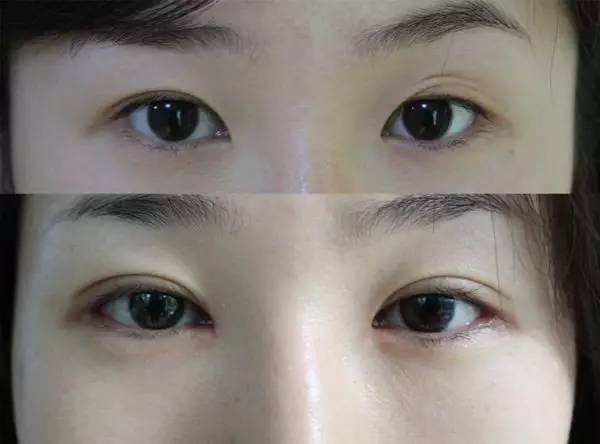 青島哪個醫生割雙眼皮和雙眼皮修復做的好？