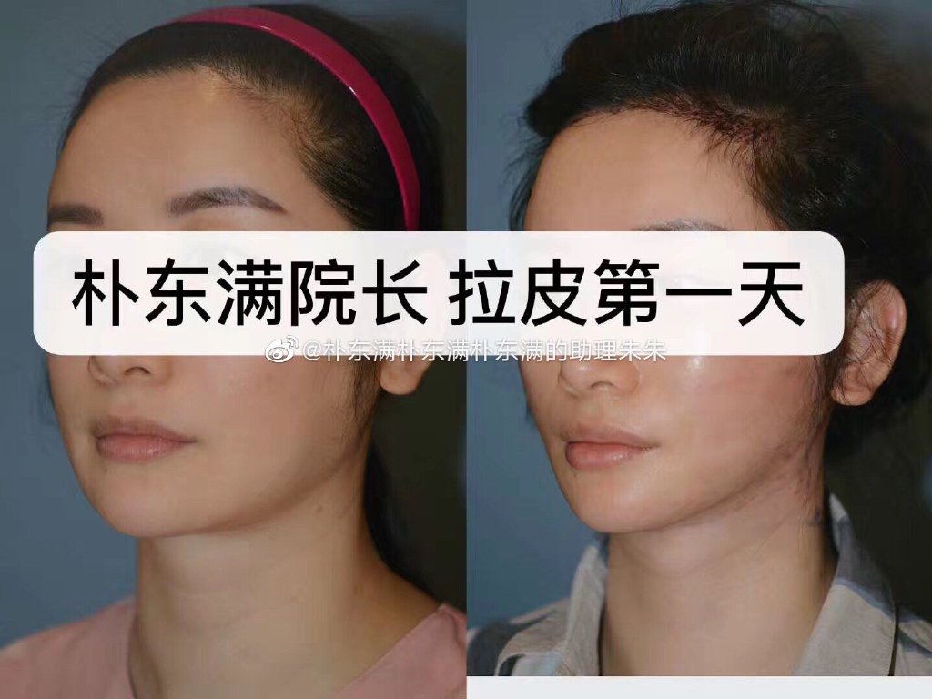樸東滿拉皮手術