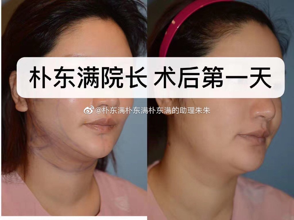 樸東滿拉皮案例