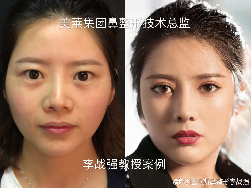 李戰強隆鼻案例