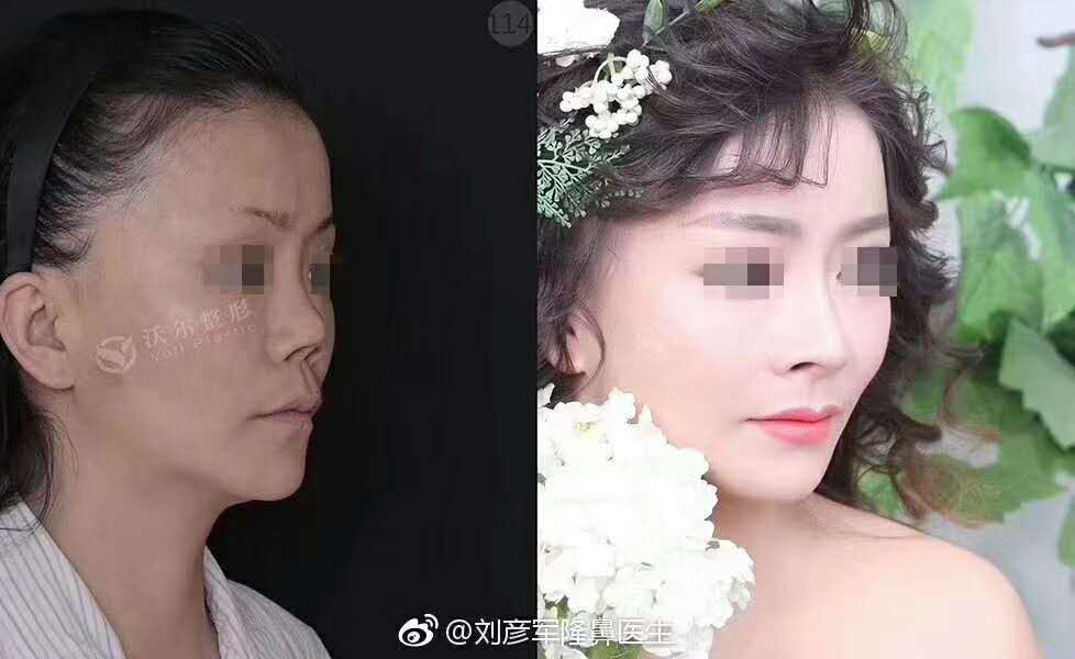 劉彥軍隆鼻案例