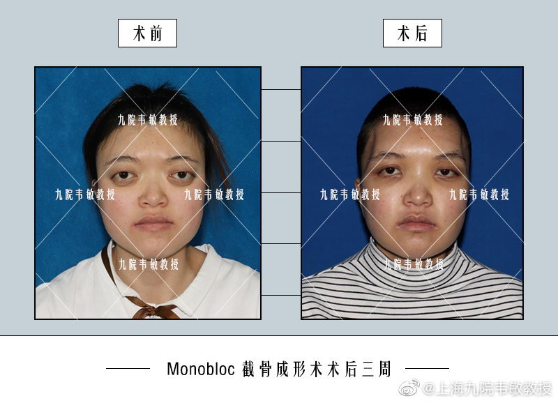 韋敏截骨案例